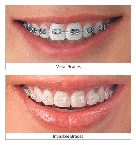 tits braces|4 Best Invisible Braces and Teeth Aligners for Adults